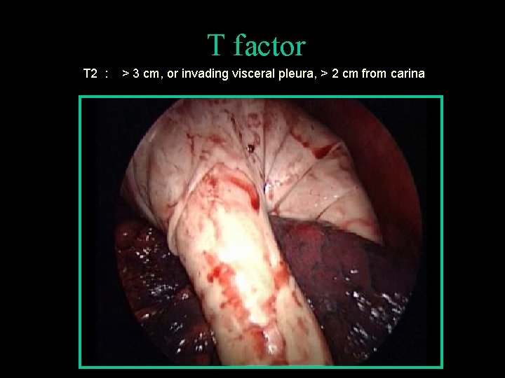 T factor T 2 : > 3 cm, or invading visceral pleura, > 2