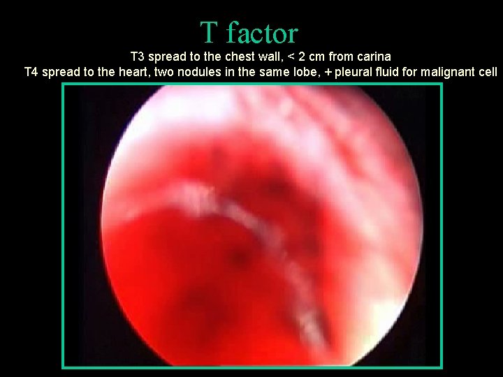 T factor T 3 spread to the chest wall, < 2 cm from carina