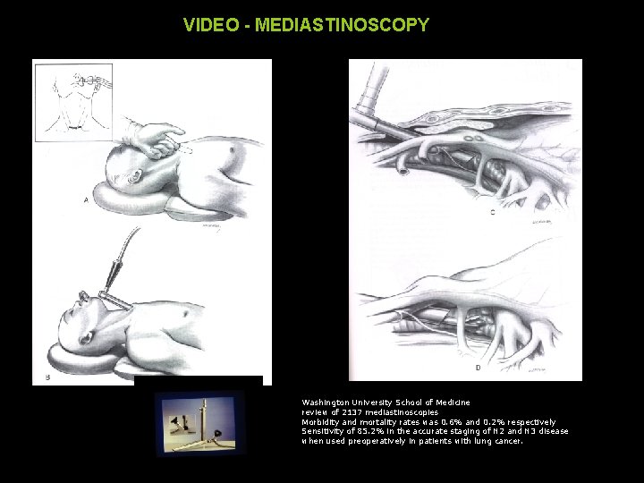 VIDEO - MEDIASTINOSCOPY Washington University School of Medicine review of 2137 mediastinoscopies Morbidity and