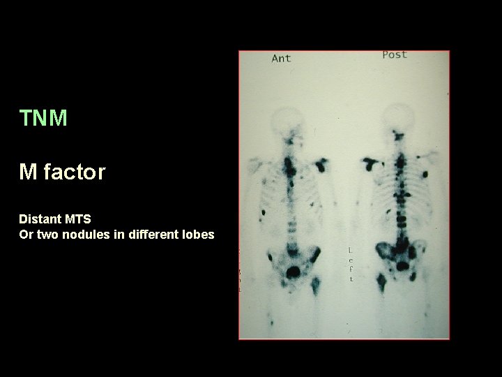 TNM M factor Distant MTS Or two nodules in different lobes 