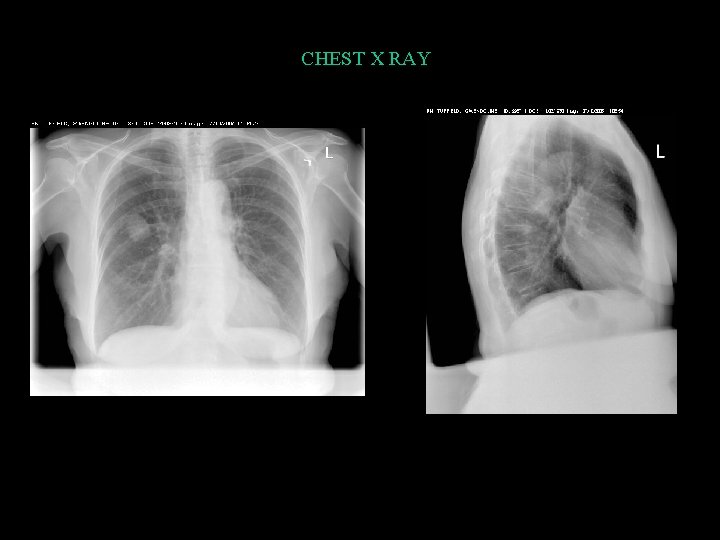 CHEST X RAY 