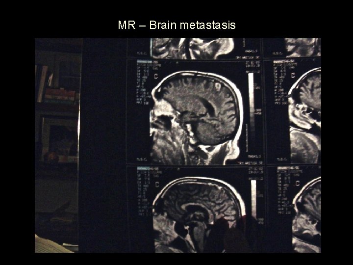 MR – Brain metastasis 
