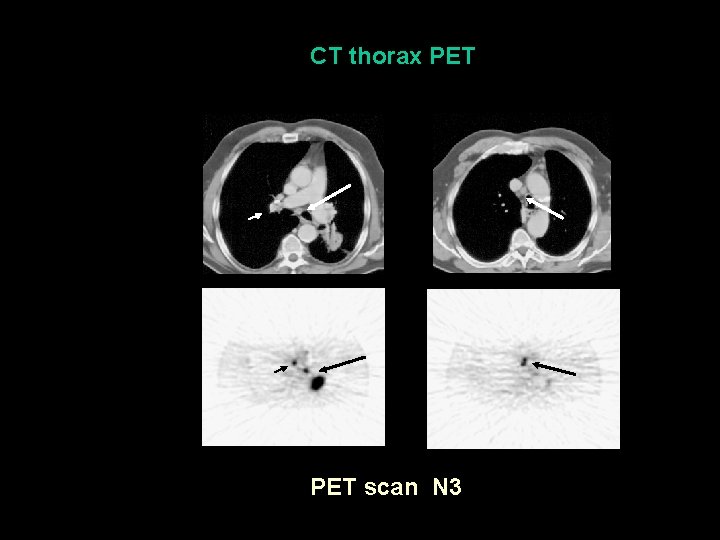 CT thorax PET scan N 3 