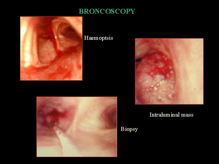 BRONCOSCOPY Haemoptsis Intraluminal mass Biopsy 