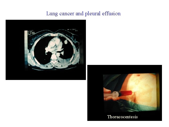 Lung cancer and pleural effusion Thoracocentesis 