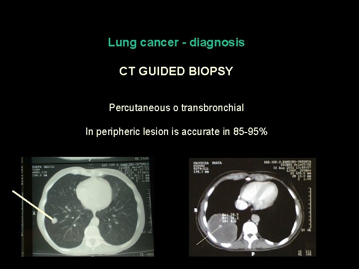 Lung cancer - diagnosis CT GUIDED BIOPSY Percutaneous o transbronchial In peripheric lesion is