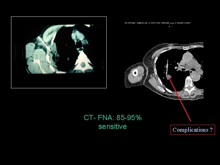 CT- FNA: 85 -95% sensitive Complications ? 