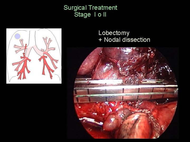 Surgical Treatment Stage I o II Lobectomy + Nodal dissection 