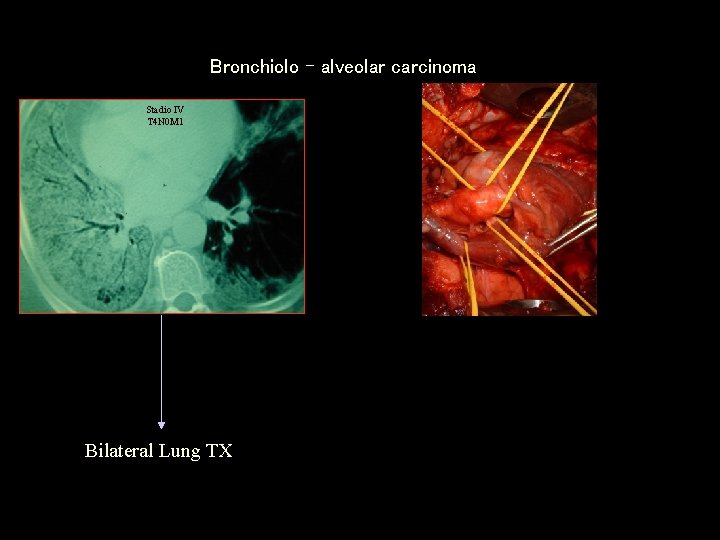 Bronchiolo – alveolar carcinoma Stadio IV T 4 N 0 M 1 Bilateral Lung