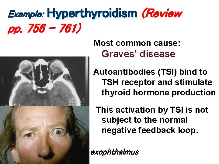 Hyperthyroidism (Review pp. 756 – 761) Example: Most common cause: Graves' disease Autoantibodies (TSI) Hyperthyroidism (Review pp. 756 – 761) Example: Most common cause: Graves' disease Autoantibodies (TSI)