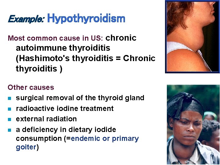 Example: Hypothyroidism Most common cause in US: chronic autoimmune thyroiditis (Hashimoto's thyroiditis = Chronic Example: Hypothyroidism Most common cause in US: chronic autoimmune thyroiditis (Hashimoto's thyroiditis = Chronic