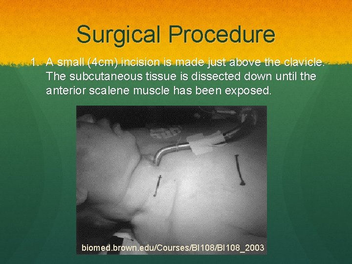 Surgical Procedure 1. A small (4 cm) incision is made just above the clavicle.