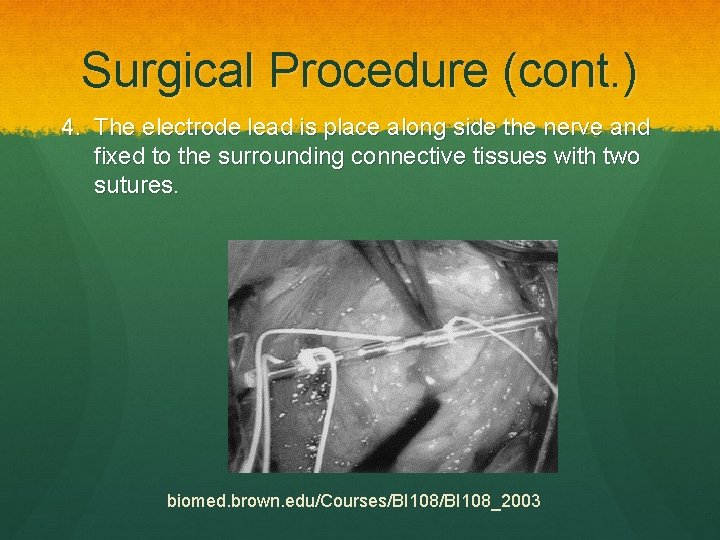 Surgical Procedure (cont. ) 4. The electrode lead is place along side the nerve