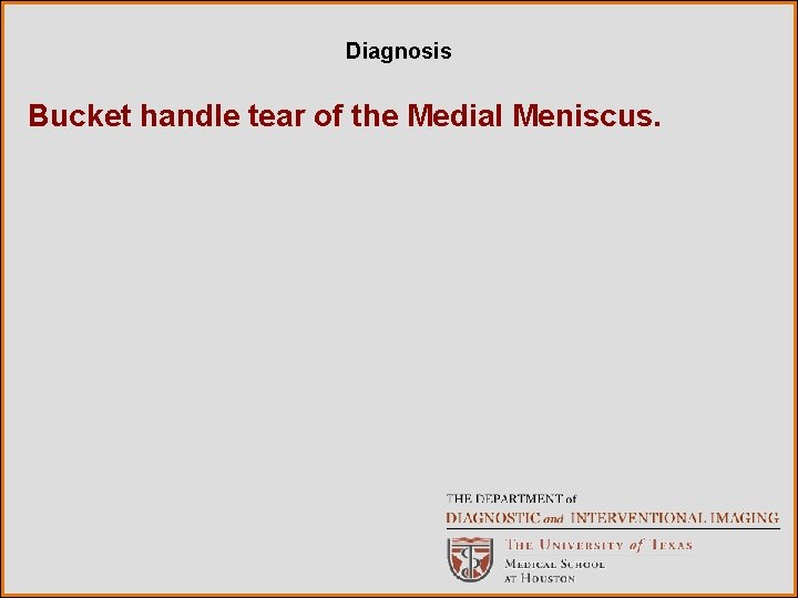 Diagnosis Bucket handle tear of the Medial Meniscus. 