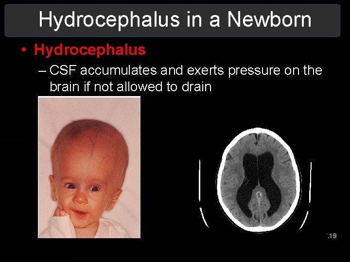 Hydrocephalus in a Newborn • Hydrocephalus – CSF accumulates and exerts pressure on the Hydrocephalus in a Newborn • Hydrocephalus – CSF accumulates and exerts pressure on the