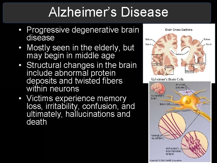 Alzheimer’s Disease • Progressive degenerative brain disease • Mostly seen in the elderly, but Alzheimer’s Disease • Progressive degenerative brain disease • Mostly seen in the elderly, but