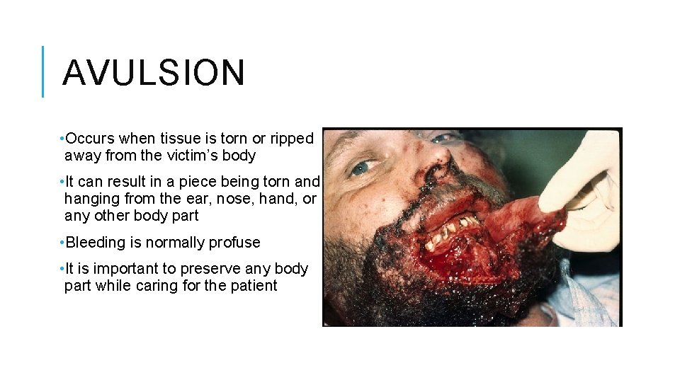 AVULSION • Occurs when tissue is torn or ripped away from the victim’s body