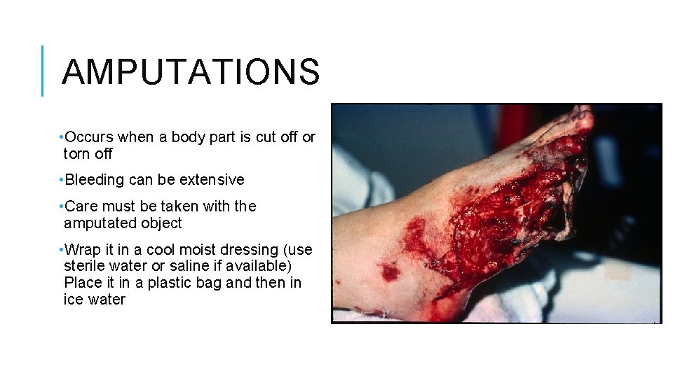AMPUTATIONS • Occurs when a body part is cut off or torn off •