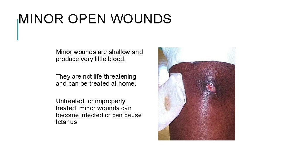 MINOR OPEN WOUNDS Minor wounds are shallow and produce very little blood. They are