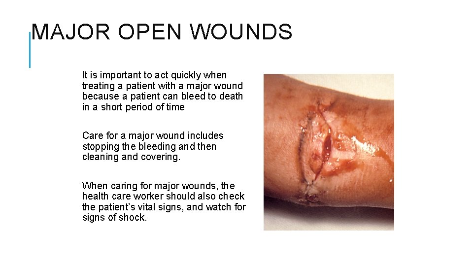 MAJOR OPEN WOUNDS It is important to act quickly when treating a patient with