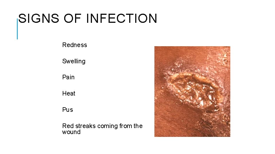 SIGNS OF INFECTION Redness Swelling Pain Heat Pus Red streaks coming from the wound