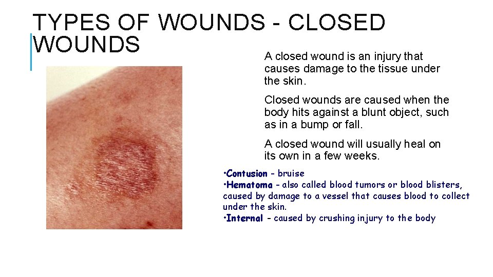 TYPES OF WOUNDS - CLOSED WOUNDS A closed wound is an injury that causes
