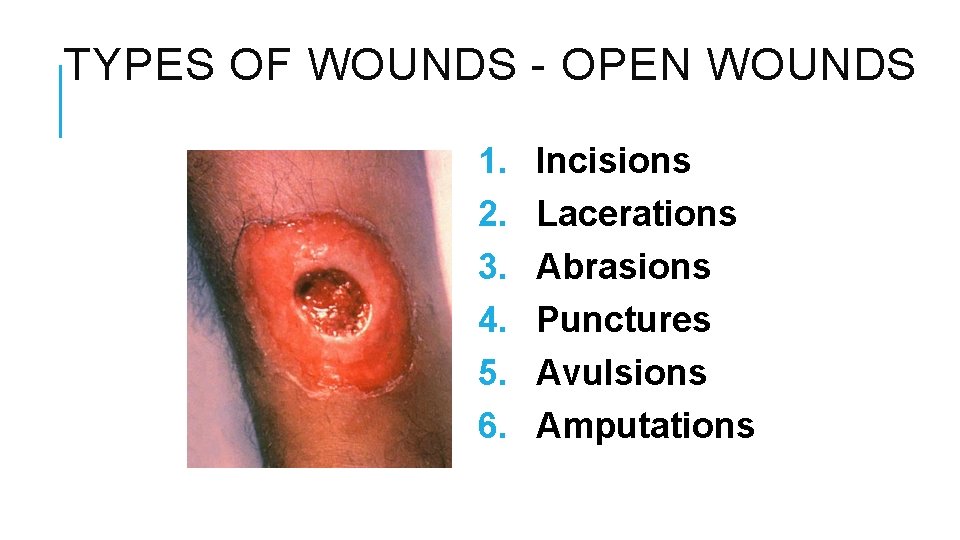 TYPES OF WOUNDS - OPEN WOUNDS 1. 2. 3. 4. 5. 6. Incisions Lacerations