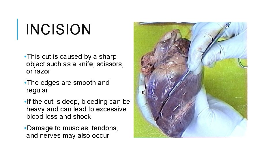 INCISION • This cut is caused by a sharp object such as a knife,
