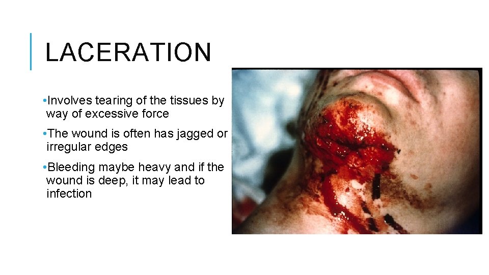 LACERATION • Involves tearing of the tissues by way of excessive force • The