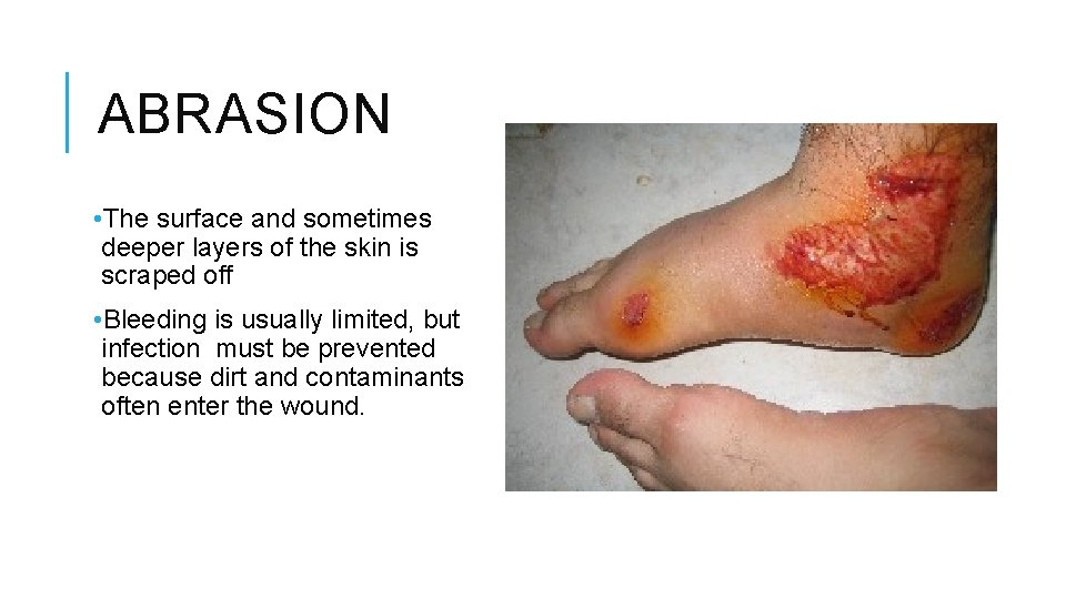 ABRASION • The surface and sometimes deeper layers of the skin is scraped off