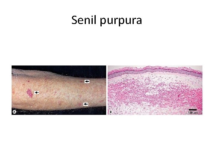 Senil purpura 