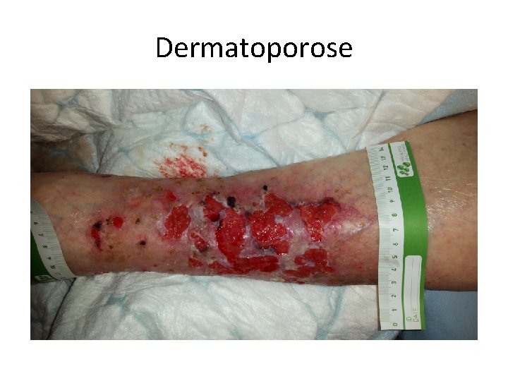 Dermatoporose 