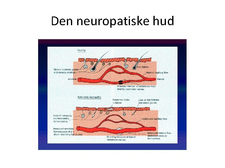 Den neuropatiske hud 