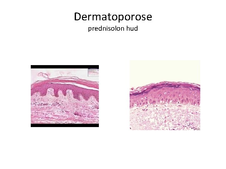 Dermatoporose prednisolon hud 