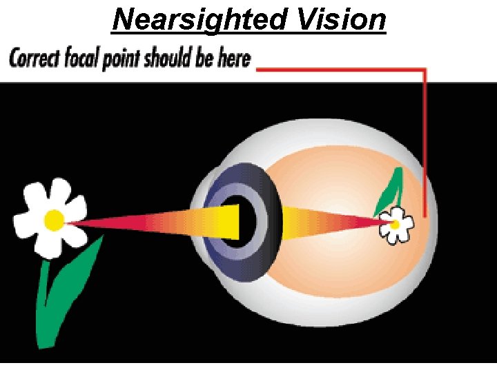 Nearsighted Vision 