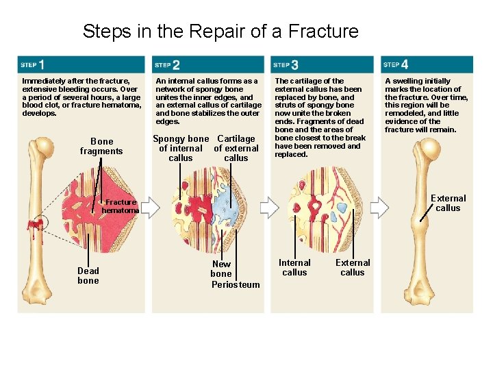 Steps in the Repair of a Fracture Immediately after the fracture, extensive bleeding occurs. Steps in the Repair of a Fracture Immediately after the fracture, extensive bleeding occurs.