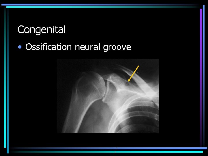 Congenital • Ossification neural groove 