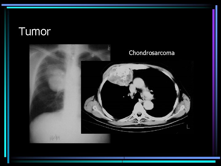 Tumor Chondrosarcoma 