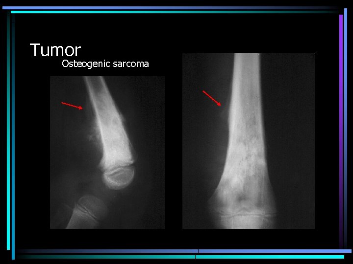 Tumor Osteogenic sarcoma 