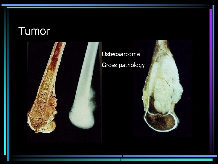 Tumor Osteosarcoma Gross pathology 