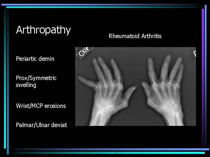 Arthropathy Periartic demin Prox/Symmetric swelling Wrist/MCP erosions Palmar/Ulnar deviat Rheumatoid Arthritis 