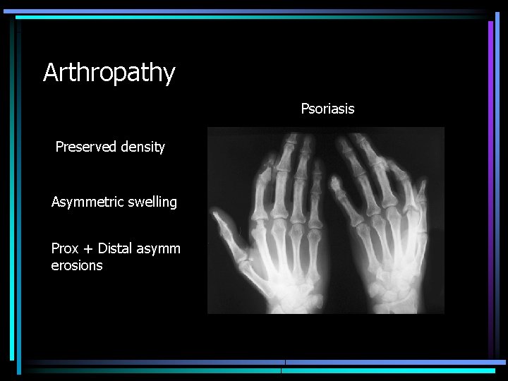Arthropathy Psoriasis Preserved density Asymmetric swelling Prox + Distal asymm erosions 