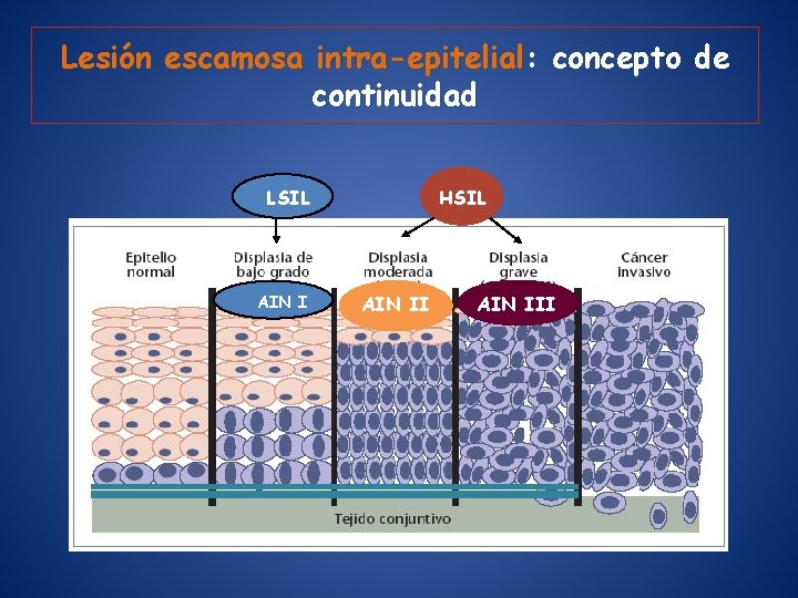 Lesión escamosa intra-epitelial: concepto de continuidad HSIL LSIL AIN III 