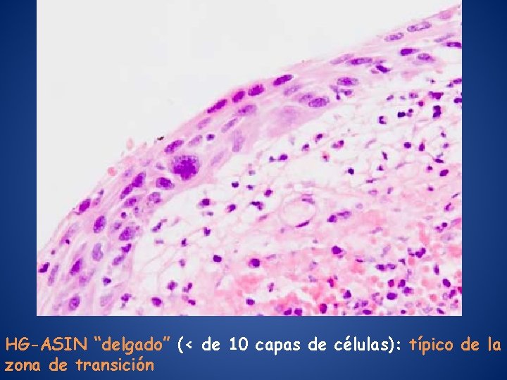 HG-ASIN “delgado” (< de 10 capas de células): típico de la zona de transición