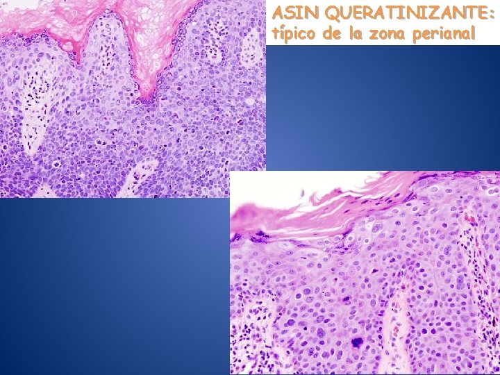 ASIN QUERATINIZANTE: típico de la zona perianal 