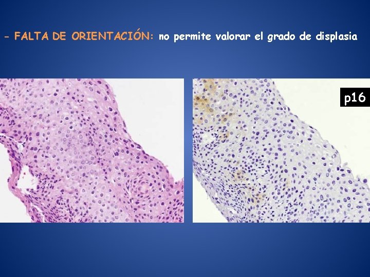 - FALTA DE ORIENTACIÓN: no permite valorar el grado de displasia p 16 