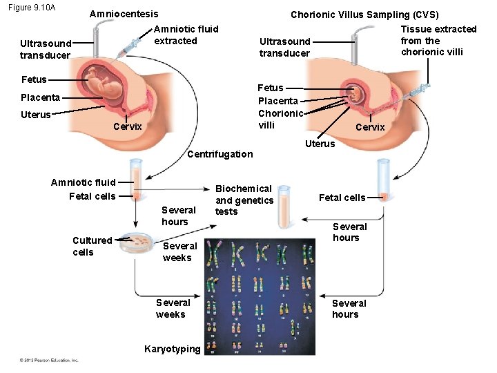 Figure 9. 10 A Amniocentesis Amniotic fluid extracted Ultrasound transducer Fetus Chorionic Villus Sampling