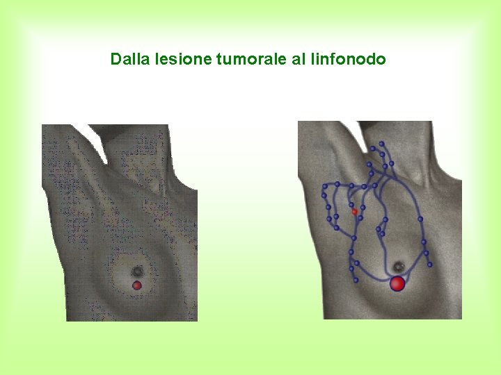 Dalla lesione tumorale al linfonodo 