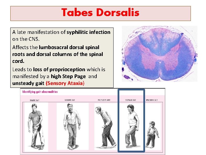 Tabes Dorsalis A late manifestation of syphilitic infection on the CNS. Affects the lumbosacral