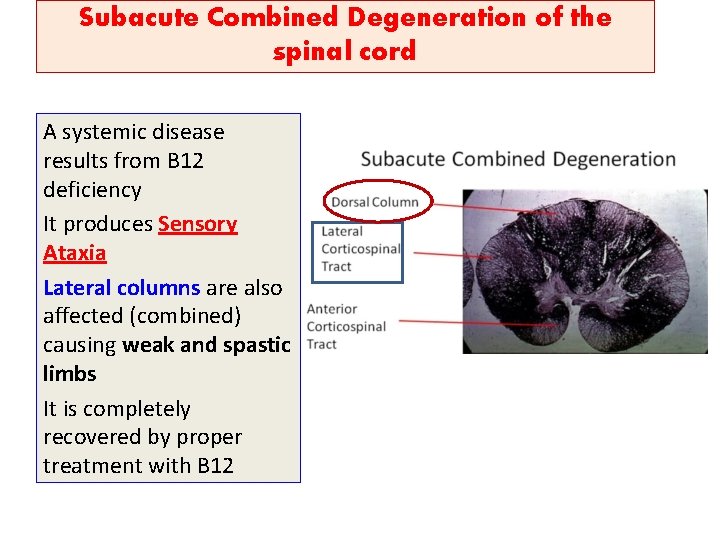 Subacute Combined Degeneration of the spinal cord A systemic disease results from B 12